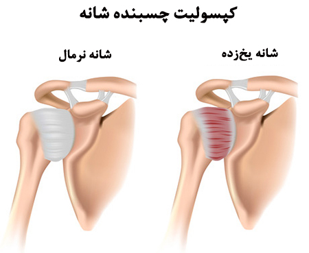 کپسولیت چسبنده یا شانه یخ زده