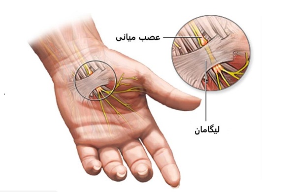 سندرم تونل کارپال