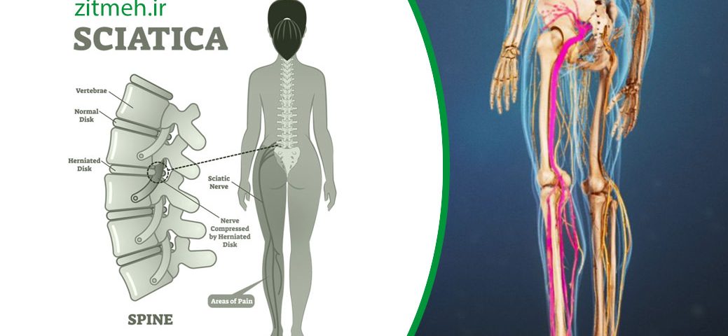 درد سیاتیک