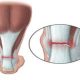 پارگی تاندون آشیل