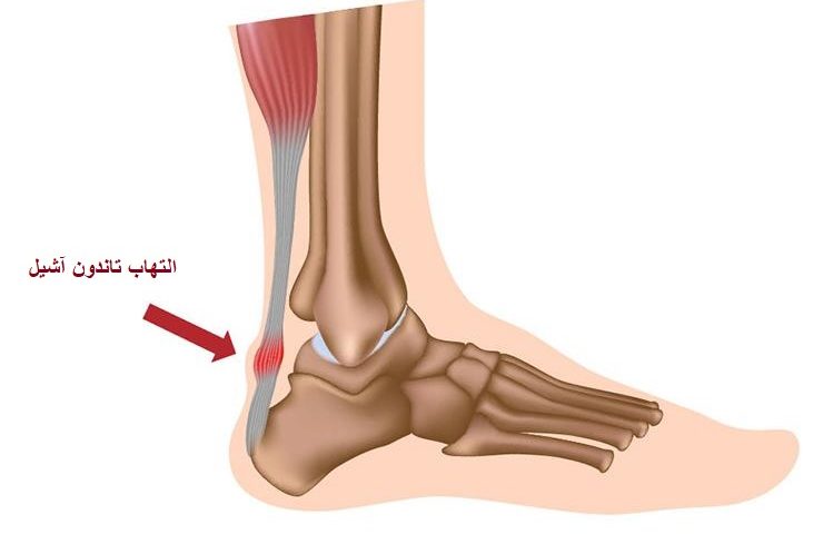 تاندونیت آشیل