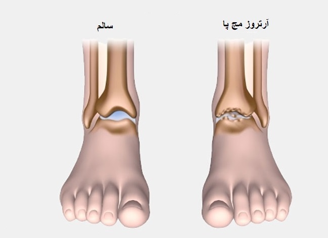 آرتروز مچ پا