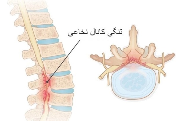 تنگی کانال نخاعی