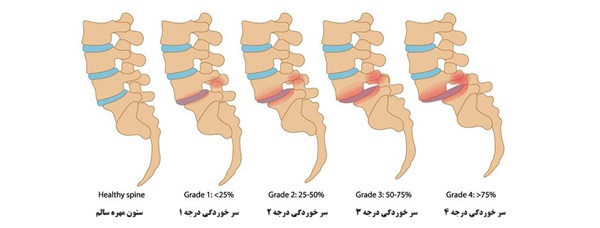 سر خوردگی مهره کمر ؛ علل، علائم و راههای درمان