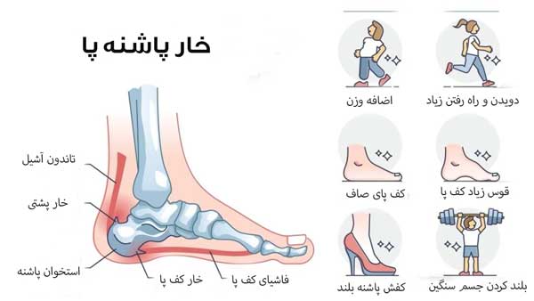 تمرینات خانگی درمان خار پاشنه
