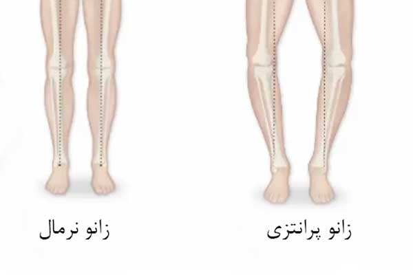 فیزیوتراپی زانو پرانتزی