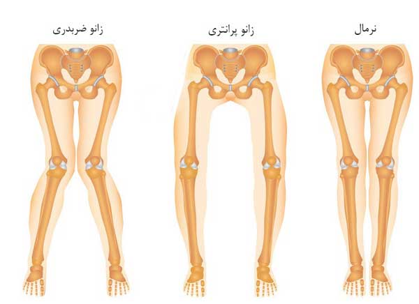 تفاوت زانوی ضربدری با زانوی پرانتزی