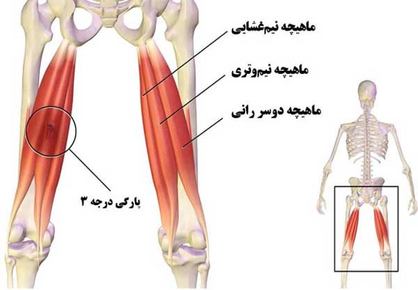 فیزیوتراپی همسترینگ